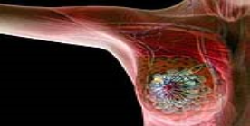 حذف ژن سرطان سینه و تخمدان قبل از تولد