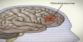 نتایج یک پژوهش جدید مبتنی بر ارتباط 5 واریانت ژنتیکی جدید با سرطان مغز